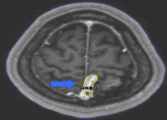 뇌수막종 방사선 수술 전 이미지