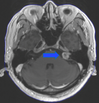 청신경초종 방사선 수술 전 이미지