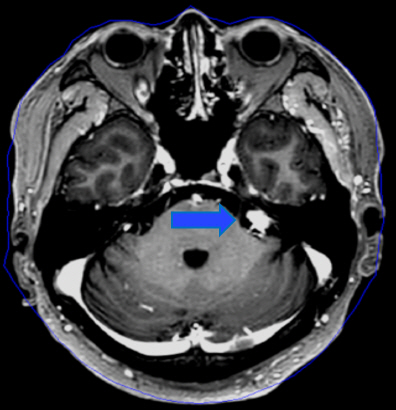 청신경초종 수술 후 1년 후 (분할치료, 청력보존) 이미지