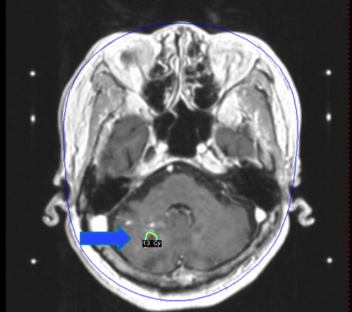 감마나이프 방사선 수술 후 추적 관찰 중 이미지